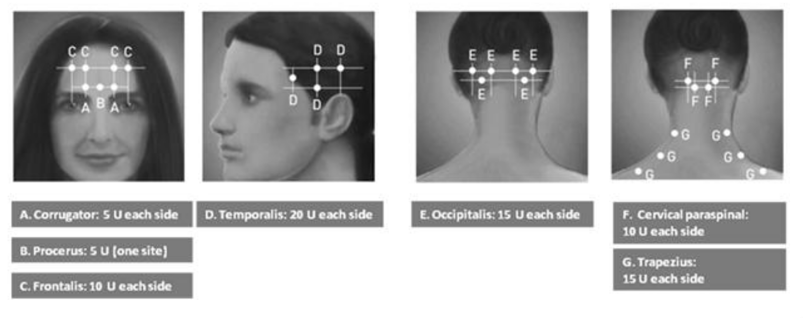 Botox For Migraines – Cellular Medicine Association